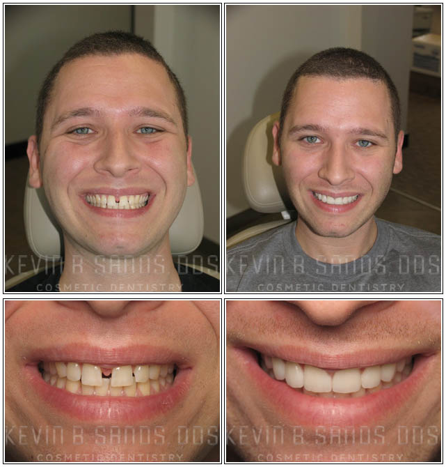 smile-makeover-before-and-after-pictures-3